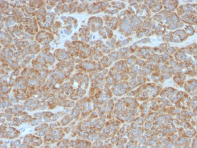 FFPE human melanoma sections stained with 100 ul anti-Bcl-2 (clone BCL2/796) at 1:300. HIER epitope retrieval prior to staining was performed in 10mM Tris 1mM EDTA, pH 9.0.